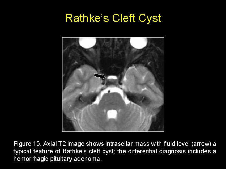 Rathke’s Cleft Cyst Figure 15. Axial T 2 image shows intrasellar mass with fluid