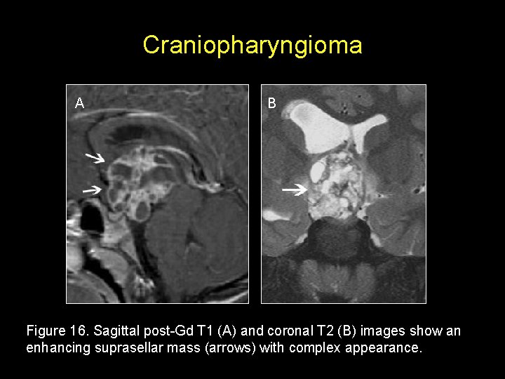 Craniopharyngioma A B Figure 16. Sagittal post-Gd T 1 (A) and coronal T 2