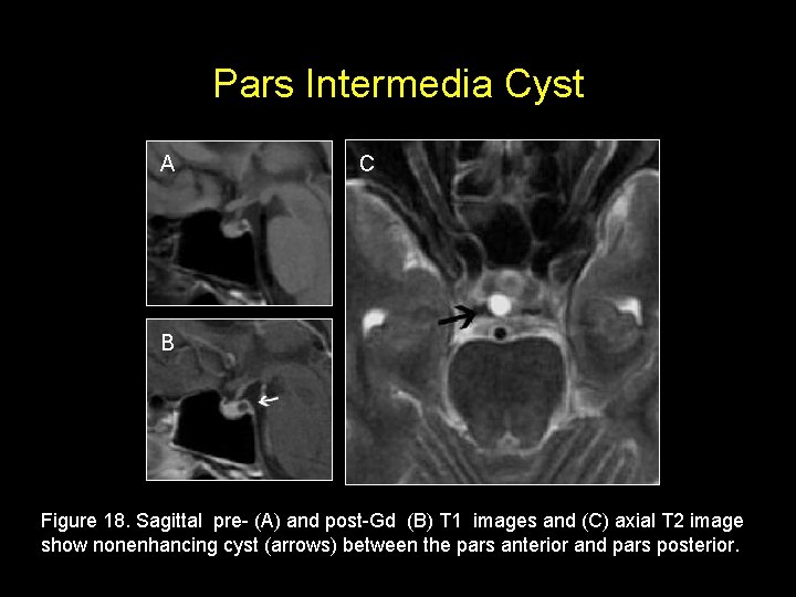 Pars Intermedia Cyst A C B Figure 18. Sagittal pre- (A) and post-Gd (B)