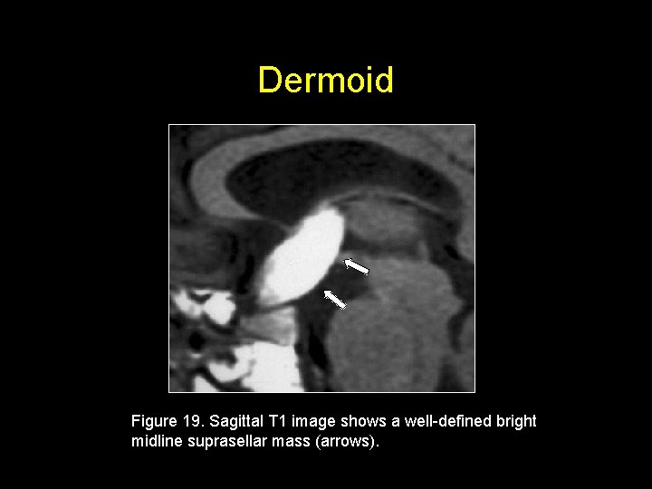 Dermoid Figure 19. Sagittal T 1 image shows a well-defined bright midline suprasellar mass