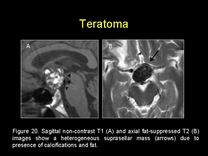 Teratoma A B Figure 20. Sagittal non-contrast T 1 (A) and axial fat-suppressed T