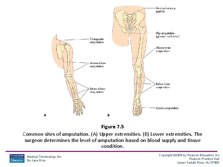 Figure 7. 5 Common sites of amputation. (A) Upper extremities. (B) Lower extremities. The