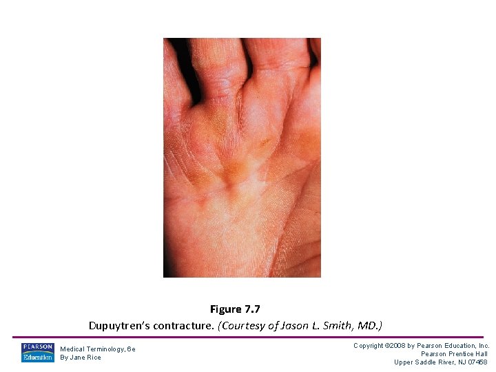 Figure 7. 7 Dupuytren’s contracture. (Courtesy of Jason L. Smith, MD. ) Medical Terminology,