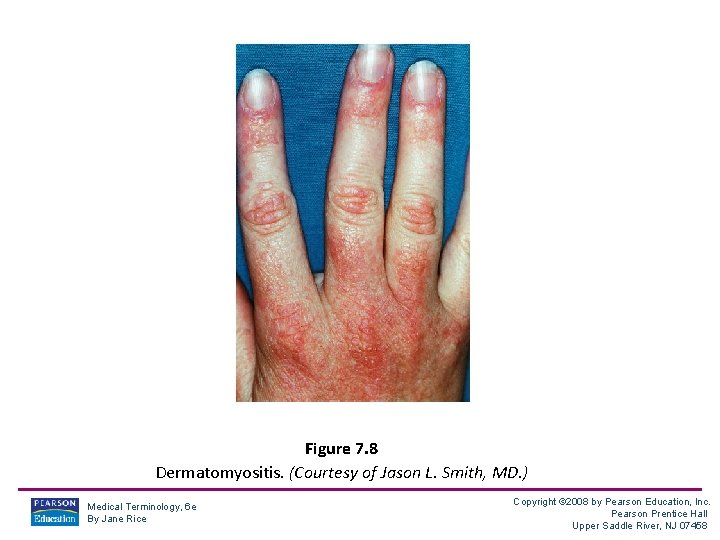 Figure 7. 8 Dermatomyositis. (Courtesy of Jason L. Smith, MD. ) Medical Terminology, 6