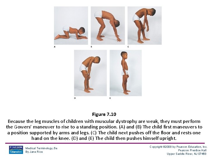 Figure 7. 10 Because the leg muscles of children with muscular dystrophy are weak,
