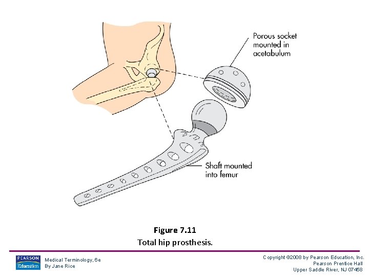Figure 7. 11 Total hip prosthesis. Medical Terminology, 6 e By Jane Rice Copyright