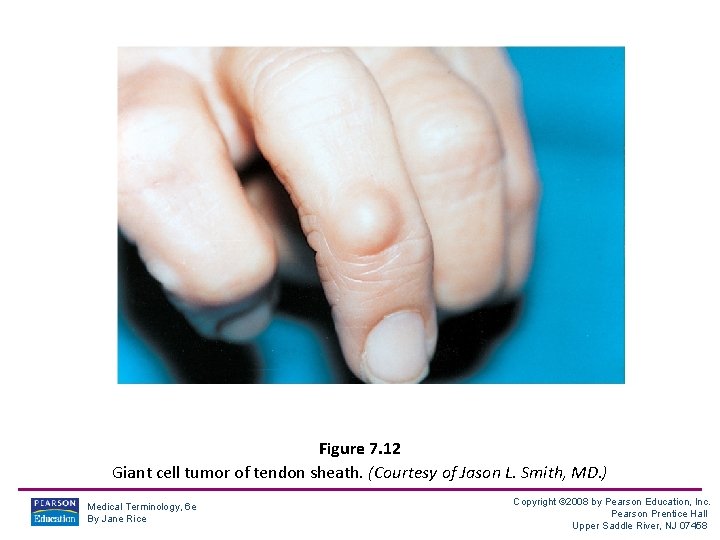 Figure 7. 12 Giant cell tumor of tendon sheath. (Courtesy of Jason L. Smith,