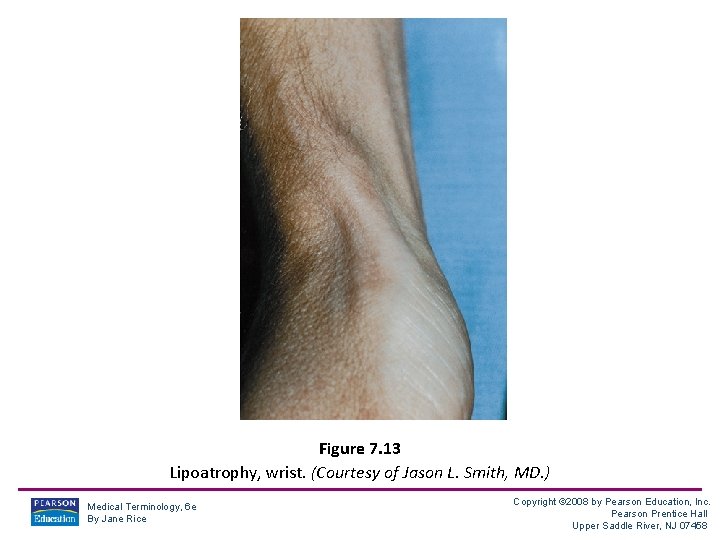 Figure 7. 13 Lipoatrophy, wrist. (Courtesy of Jason L. Smith, MD. ) Medical Terminology,