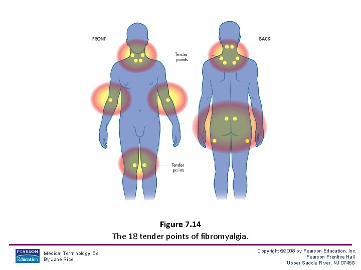 Figure 7. 14 The 18 tender points of fibromyalgia. Medical Terminology, 6 e By