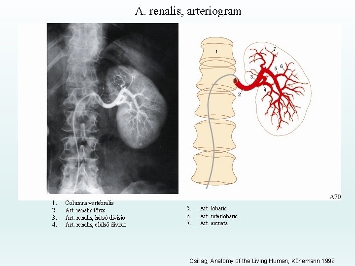 A. renalis, arteriogram 1. 2. 3. 4. Columna vertebralis Art. renalis törzs Art. renalis,