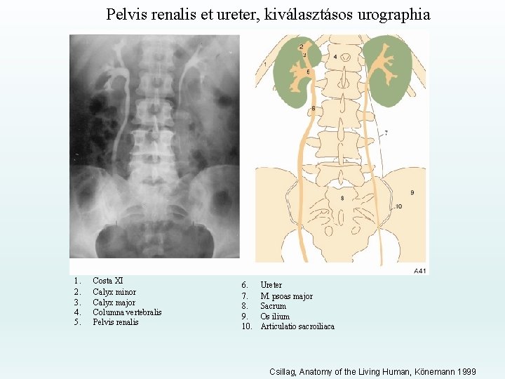 Pelvis renalis et ureter, kiválasztásos urographia 1. 2. 3. 4. 5. Costa XI Calyx