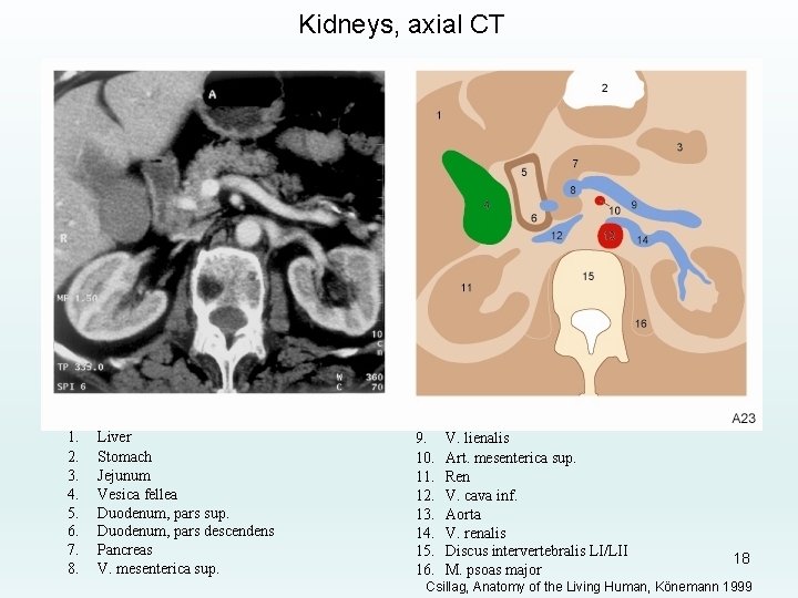 Kidneys, axial CT 1. 2. 3. 4. 5. 6. 7. 8. Liver Stomach Jejunum