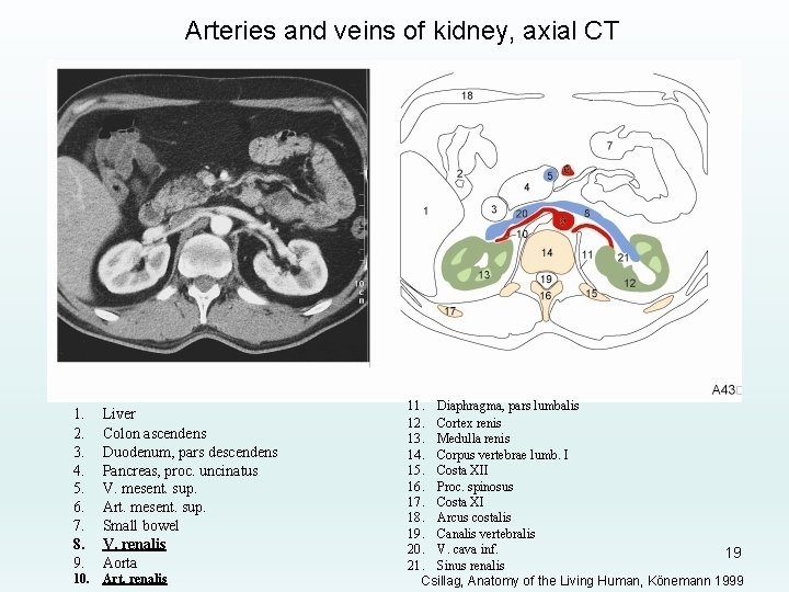 Arteries and veins of kidney, axial CT 1. 2. 3. 4. 5. 6. 7.