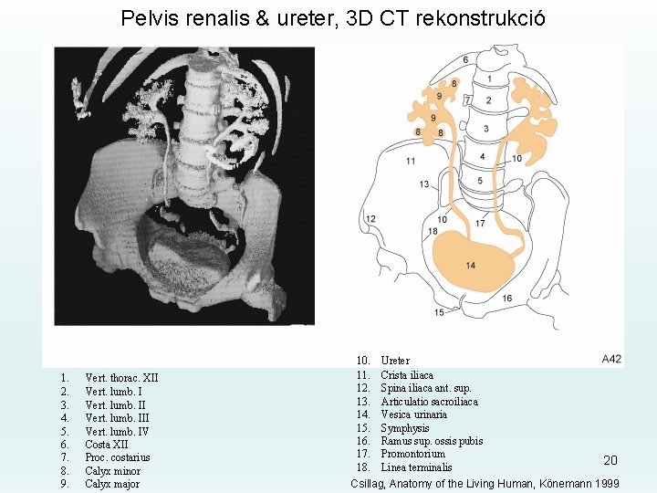 Pelvis renalis & ureter, 3 D CT rekonstrukció 1. 2. 3. 4. 5. 6.