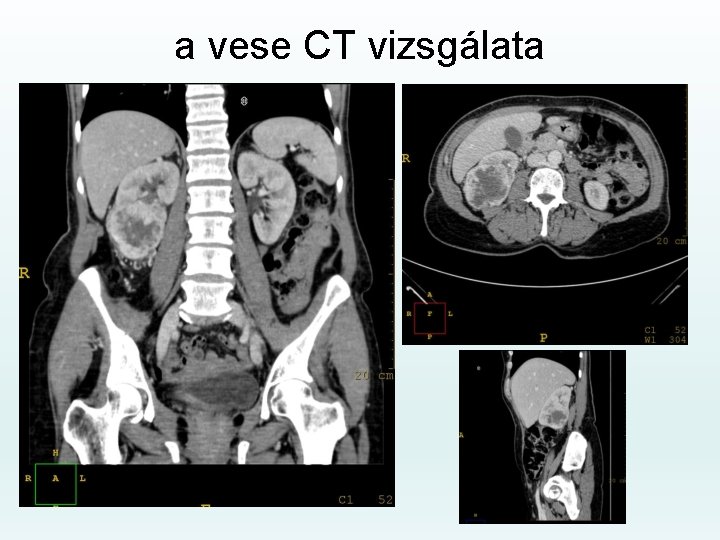 a vese CT vizsgálata 