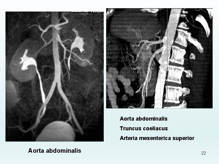 Aorta abdominalis Truncus coeliacus Arteria mesenterica superior Aorta abdominalis 22 