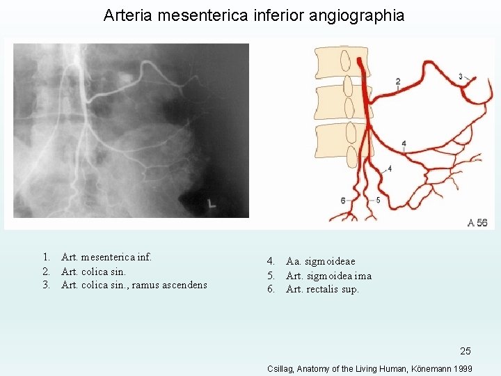 Arteria mesenterica inferior angiographia 1. Art. mesenterica inf. 2. Art. colica sin. 3. Art.
