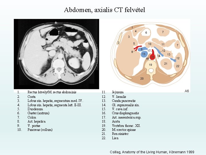 Abdomen, axialis CT felvétel 1. 2. 3. 4. 5. 6. 7. 8. 9. 10.