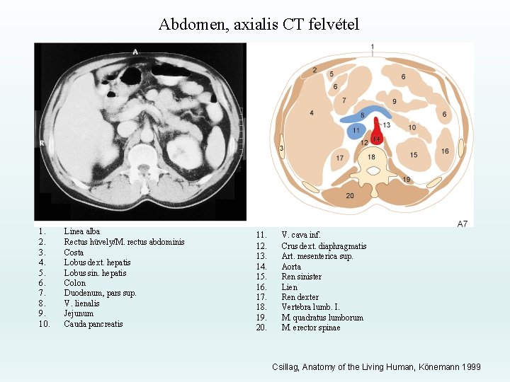 Abdomen, axialis CT felvétel 1. 2. 3. 4. 5. 6. 7. 8. 9. 10.