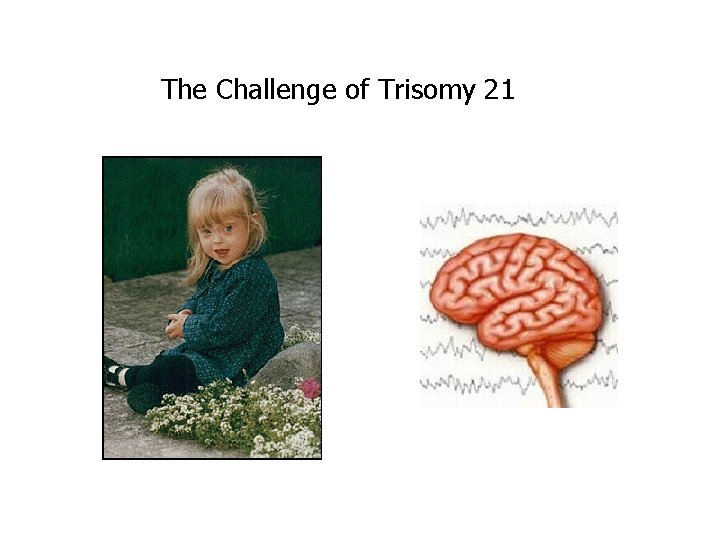 The Challenge of Trisomy 21 