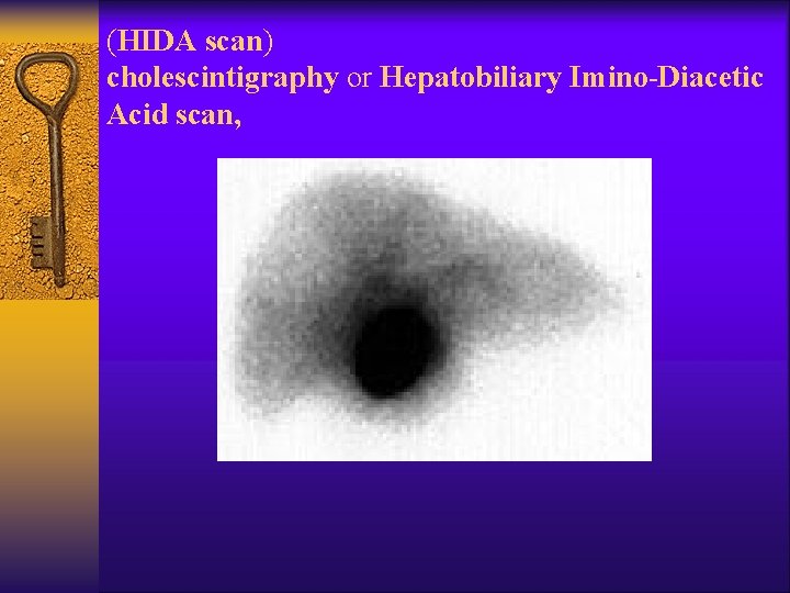 (HIDA scan) cholescintigraphy or Hepatobiliary Imino-Diacetic Acid scan, 