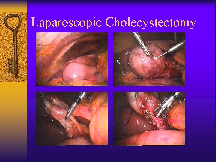 Laparoscopic Cholecystectomy 