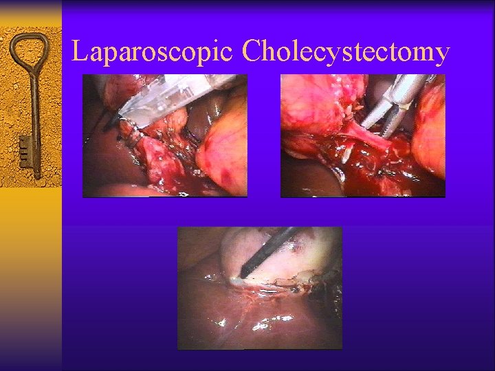 Laparoscopic Cholecystectomy 