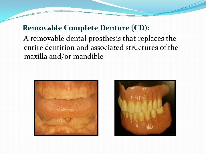 Removable Complete Denture (CD): A removable dental prosthesis that replaces the entire dentition and