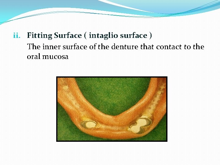 ii. Fitting Surface ( intaglio surface ) The inner surface of the denture that