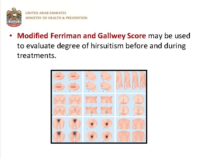  • Modified Ferriman and Gallwey Score may be used to evaluate degree of
