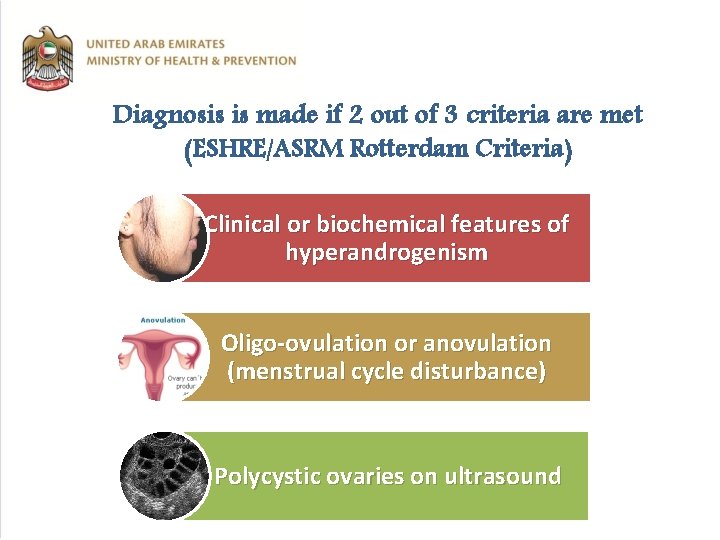 Diagnosis is made if 2 out of 3 criteria are met (ESHRE/ASRM Rotterdam Criteria)