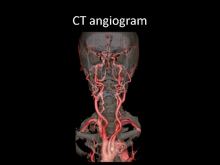 CT angiogram 