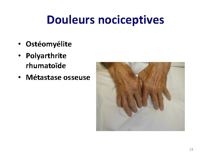 Douleurs nociceptives • Ostéomyélite • Polyarthrite rhumatoïde • Métastase osseuse 13 