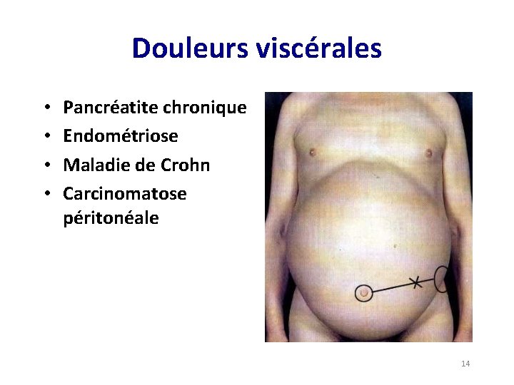 Douleurs viscérales • • Pancréatite chronique Endométriose Maladie de Crohn Carcinomatose péritonéale 14 