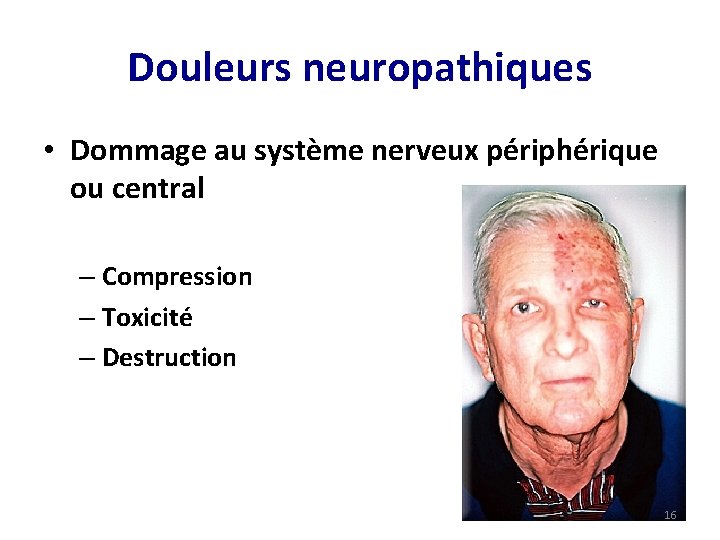 Douleurs neuropathiques • Dommage au système nerveux périphérique ou central – Compression – Toxicité