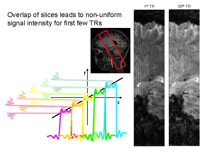 1 st TR Overlap of slices leads to non-uniform signal intensity for first few