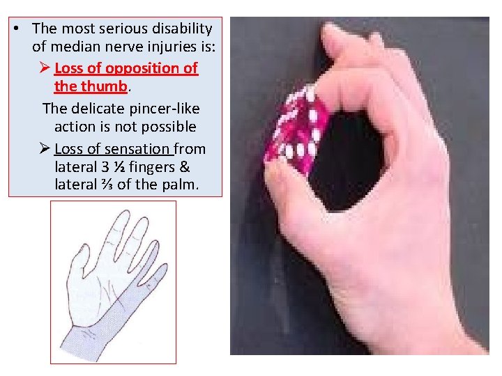  • The most serious disability of median nerve injuries is: Ø Loss of