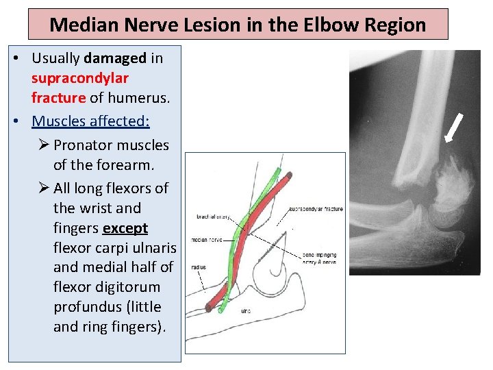 Median Nerve Lesion in the Elbow Region • Usually damaged in supracondylar fracture of