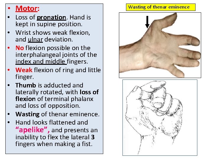  • Motor: • Loss of pronation. Hand is kept in supine position. •