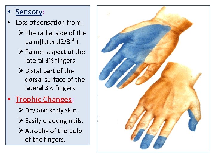  • Sensory: • Loss of sensation from: Ø The radial side of the