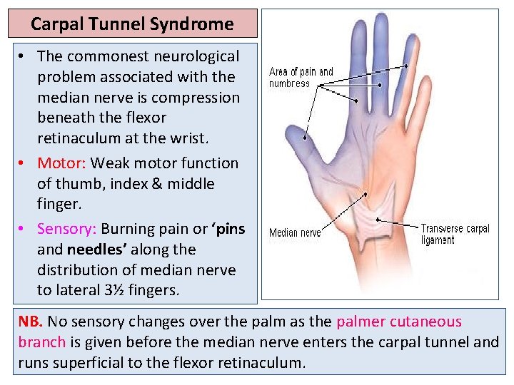 Carpal Tunnel Syndrome • The commonest neurological problem associated with the median nerve is