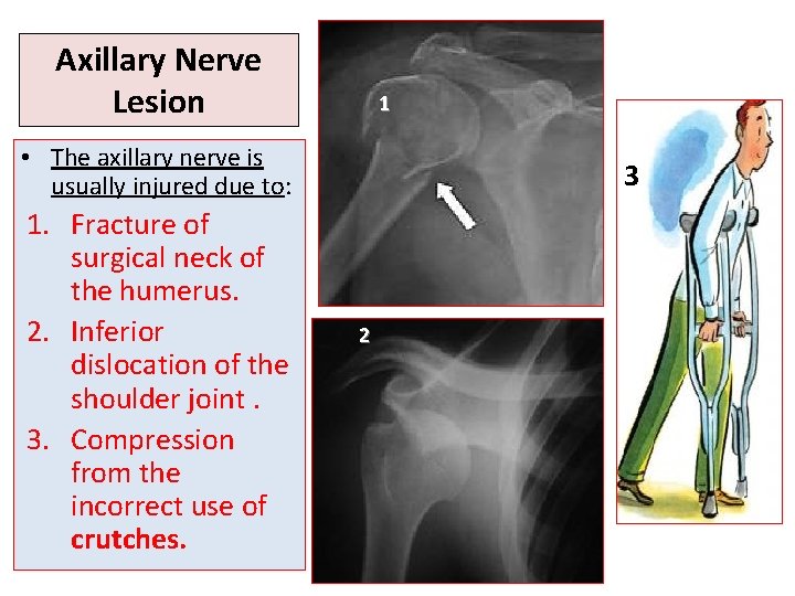 Axillary Nerve Lesion 1 • The axillary nerve is usually injured due to: 1.