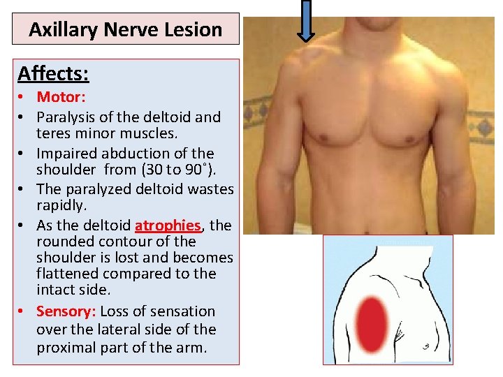 Axillary Nerve Lesion Affects: • Motor: • Paralysis of the deltoid and teres minor