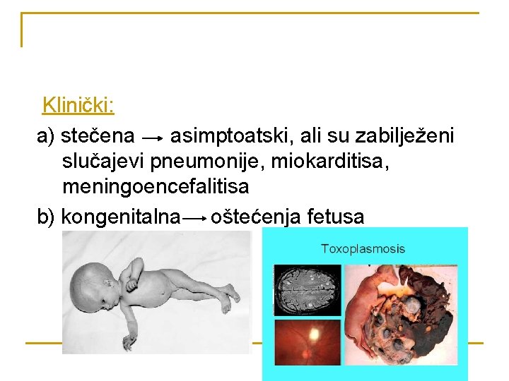 Klinički: a) stečena asimptoatski, ali su zabilježeni slučajevi pneumonije, miokarditisa, meningoencefalitisa b) kongenitalna oštećenja