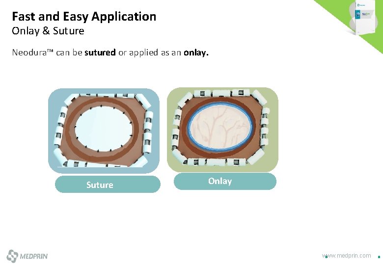 Fast and Easy Application Onlay & Suture Neodura™ can be sutured or applied as