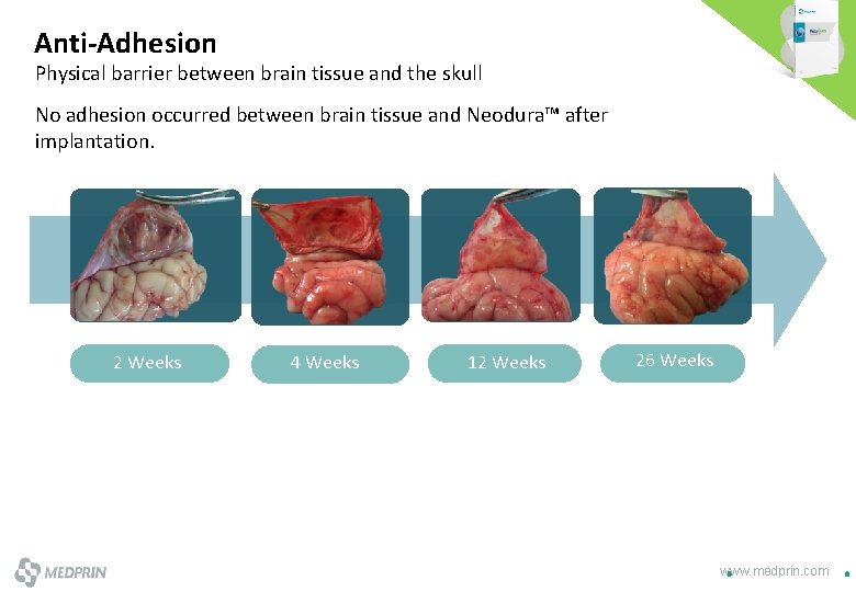 Anti-Adhesion Physical barrier between brain tissue and the skull No adhesion occurred between brain
