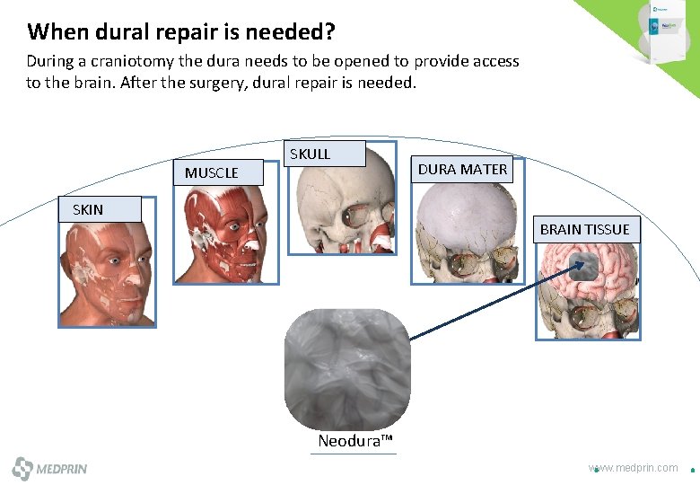 When dural repair is needed? During a craniotomy the dura needs to be opened