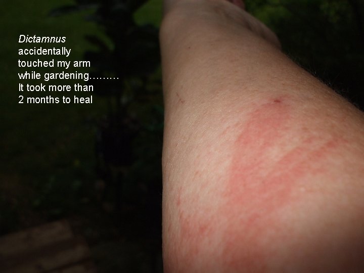 Dictamnus accidentally touched my arm while gardening……… It took more than 2 months to