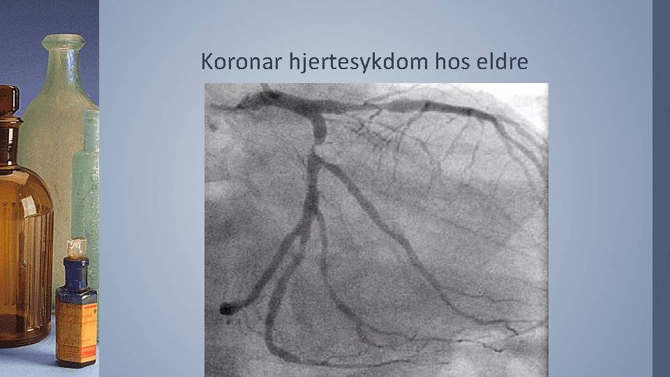 Koronar hjertesykdom hos eldre 