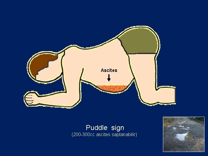 Ascites Puddle sign (200 -300 cc ascites saptanabilir) 